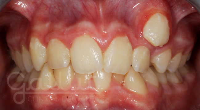 caso ortodoncia invisalign teen (antes)