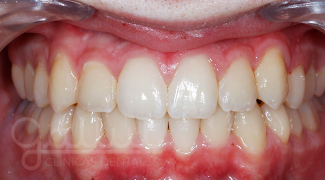 caso ortodoncia invisalign teen (despues)