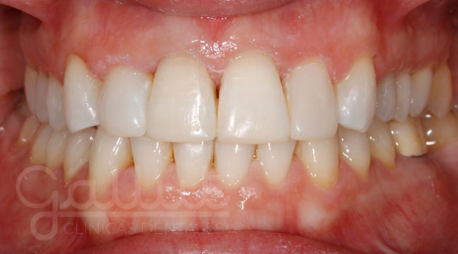 resultado de tratamiento de ortodoncia invisible, blanqueamiento y reconstrucciones