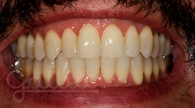 caso 2 blanqueamiento dental antes clinicas gallut