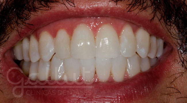 caso 2 blanqueamiento dental despues clinicas gallut