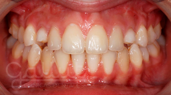 caso 4 blanqueamiento dental antes clinicas gallut