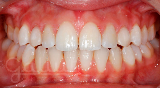 caso 4 blanqueamiento dental despues clinicas gallut