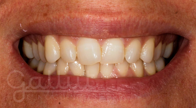 caso 5 blanqueamiento dental antes clinicas gallut