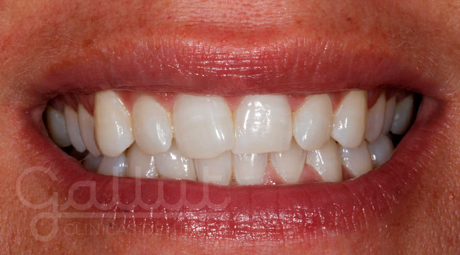 caso 5 blanqueamiento dental despues clinicas gallut